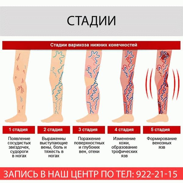 Документы и справки для призывников с варикозом